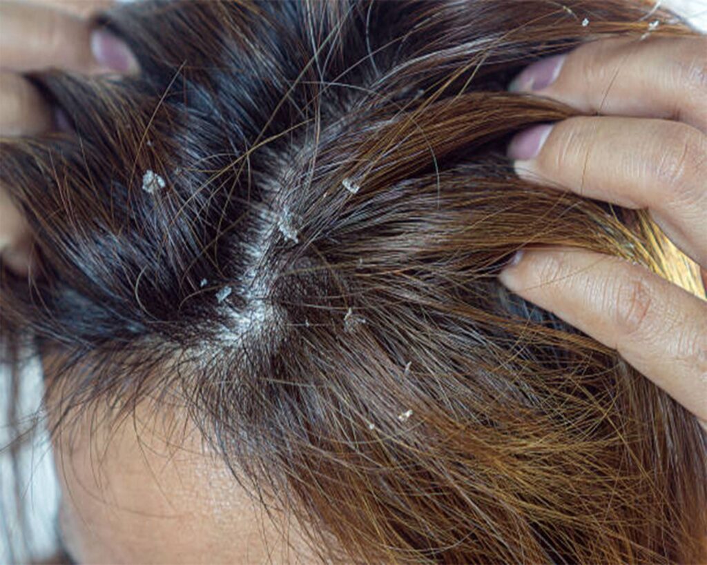 Say Goodbye To Flakes The Power Of Anti Dandruff Shampoo